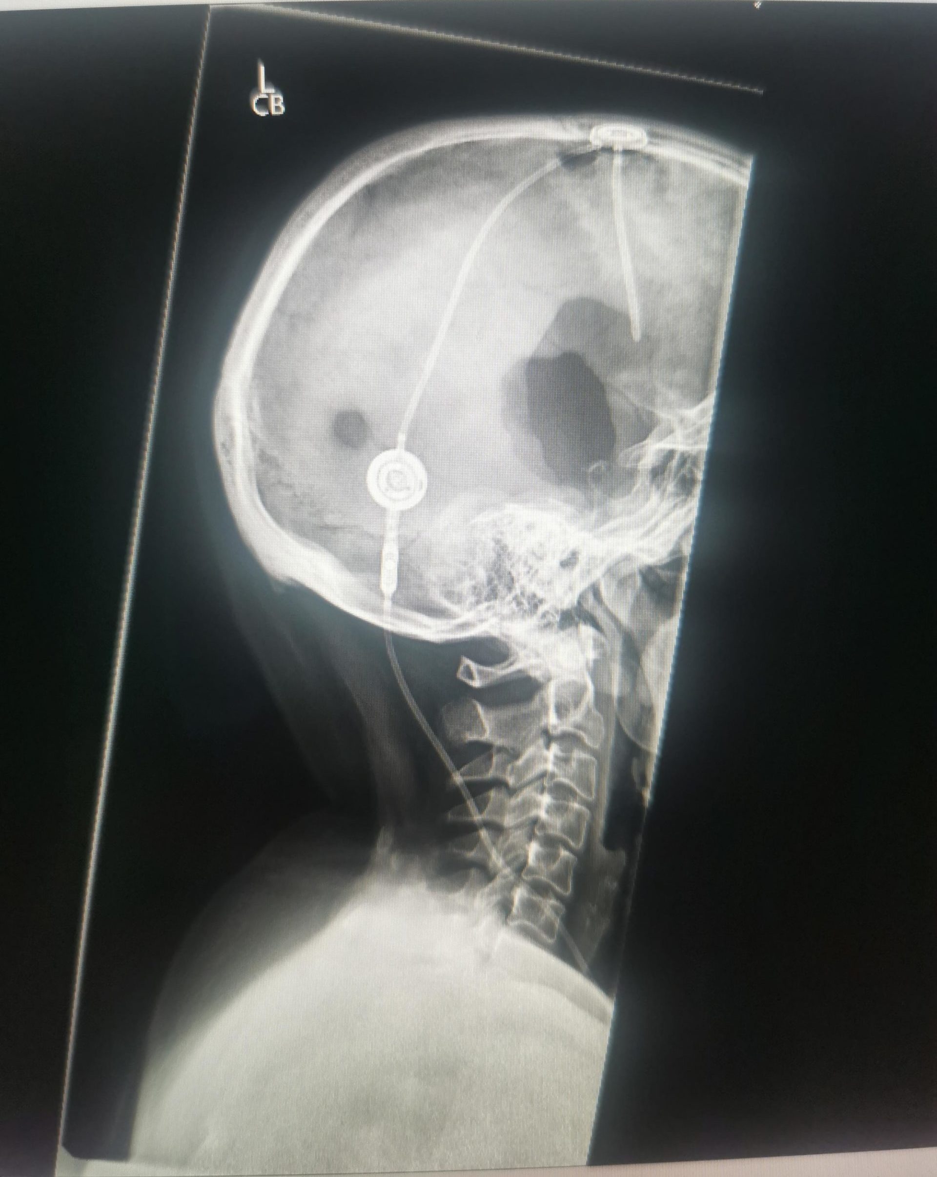 A head x-ray showing a tube in the brain