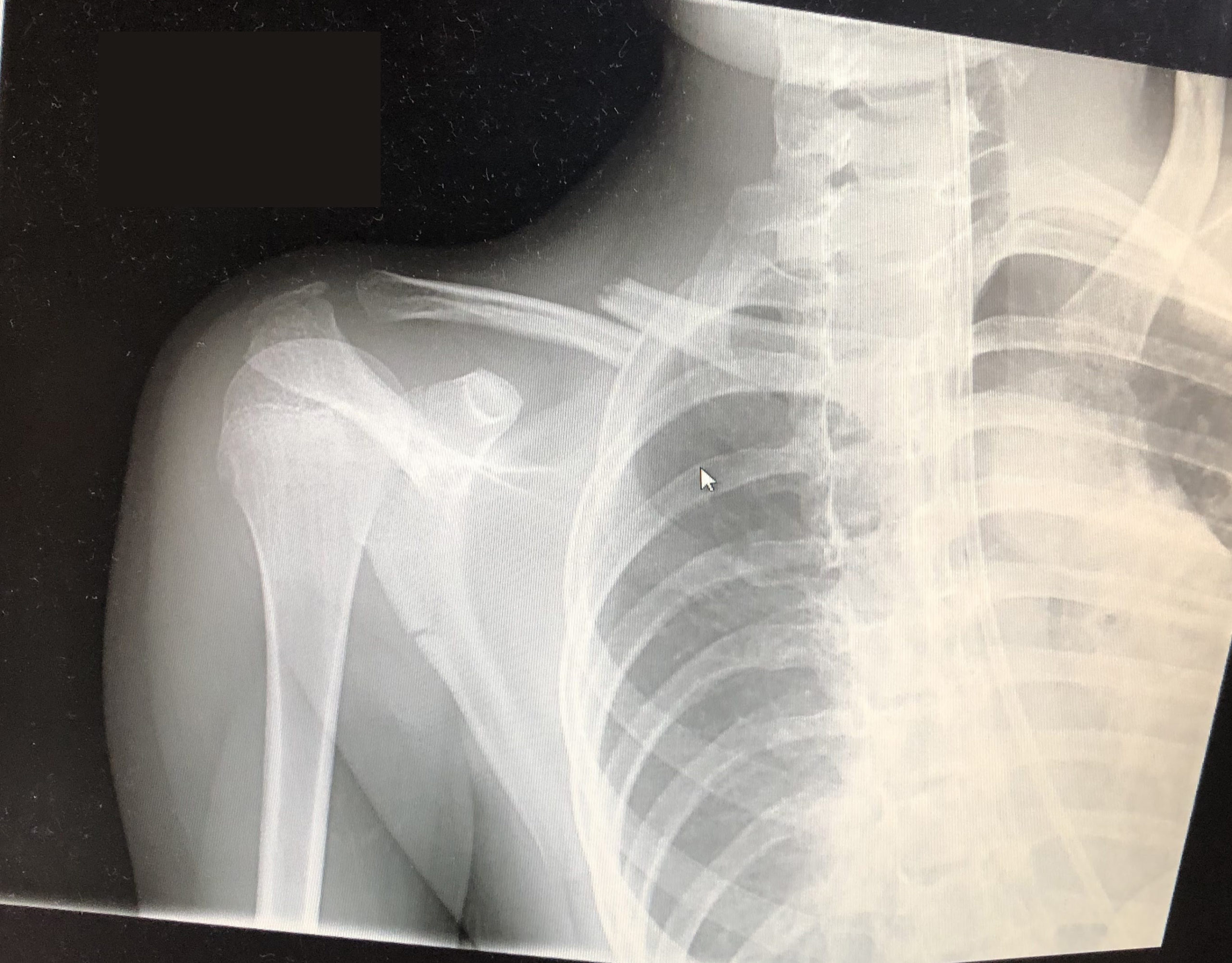 An x-ray showing a broken collar bone