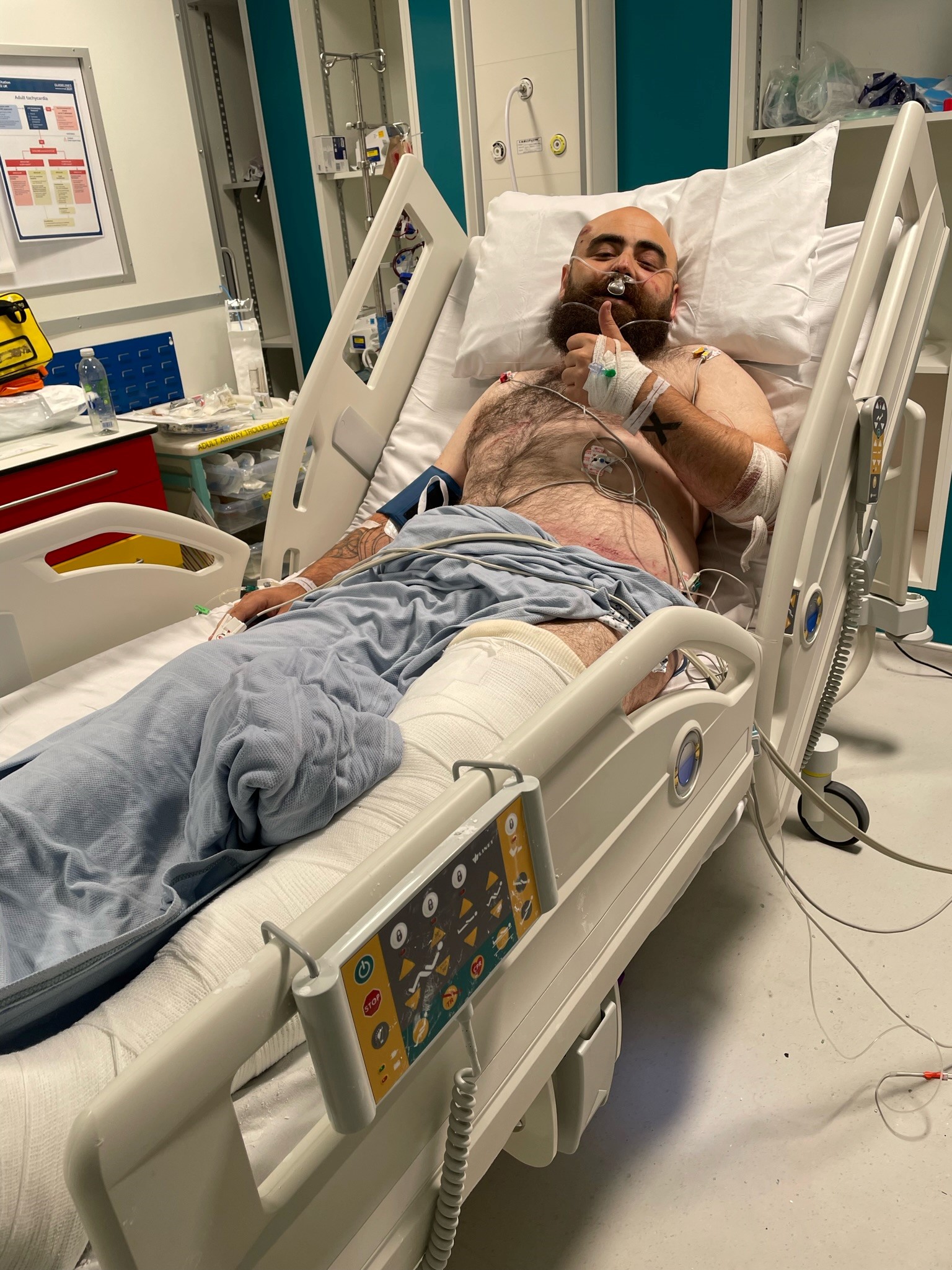 A man lying in a hospital bed. He has a long cast up his left leg and is connected to wires and tubes.