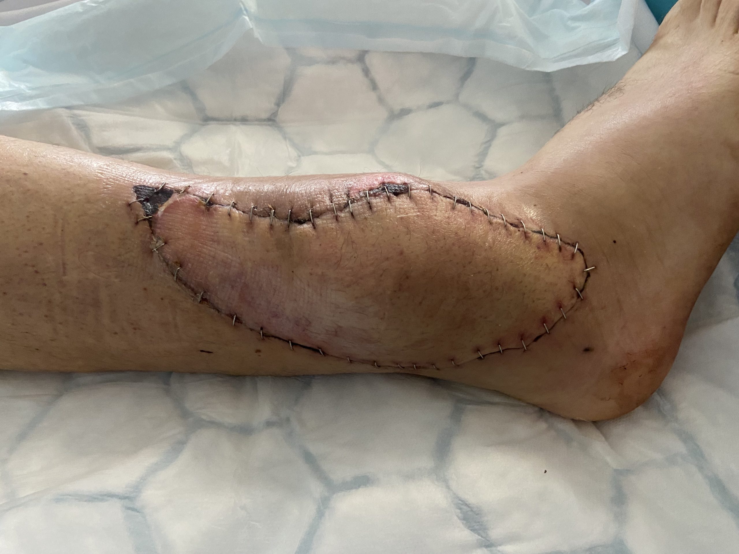 An ankle post-surgery.