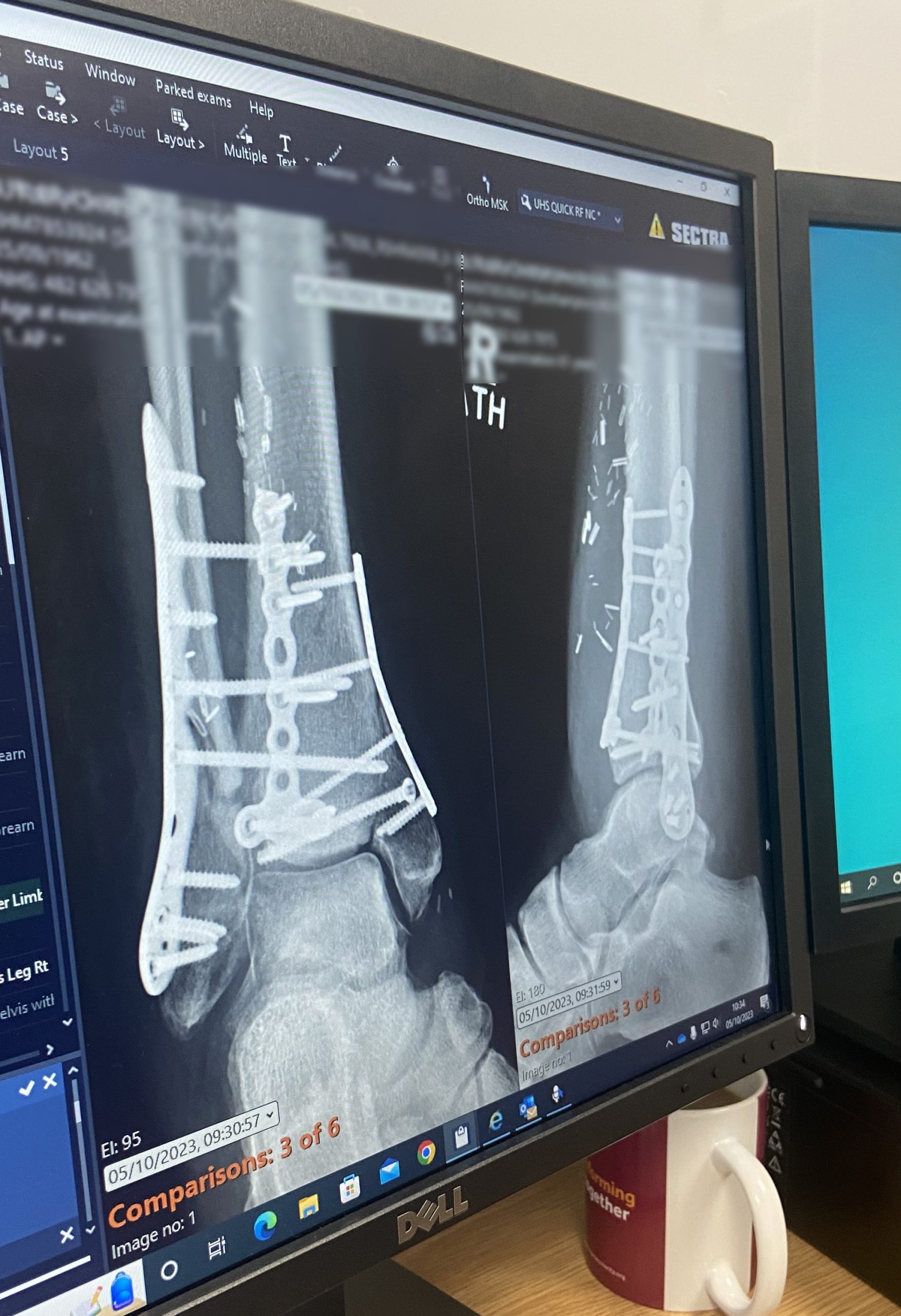 An X-ray showing multiple screws in Chris' ankle.