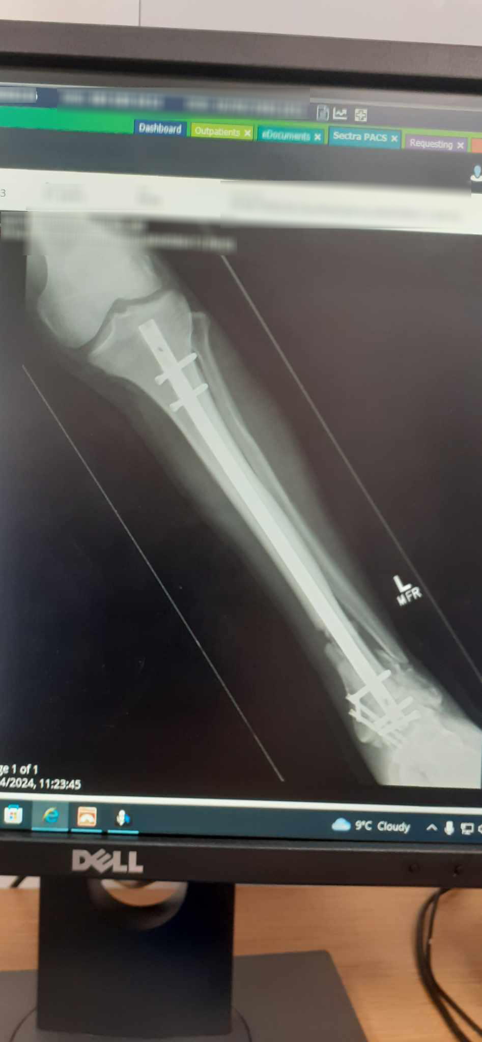 An X-ray on a computer screen. It shows a leg that has a metal rod all the way down it with screws and pins holding it in place.