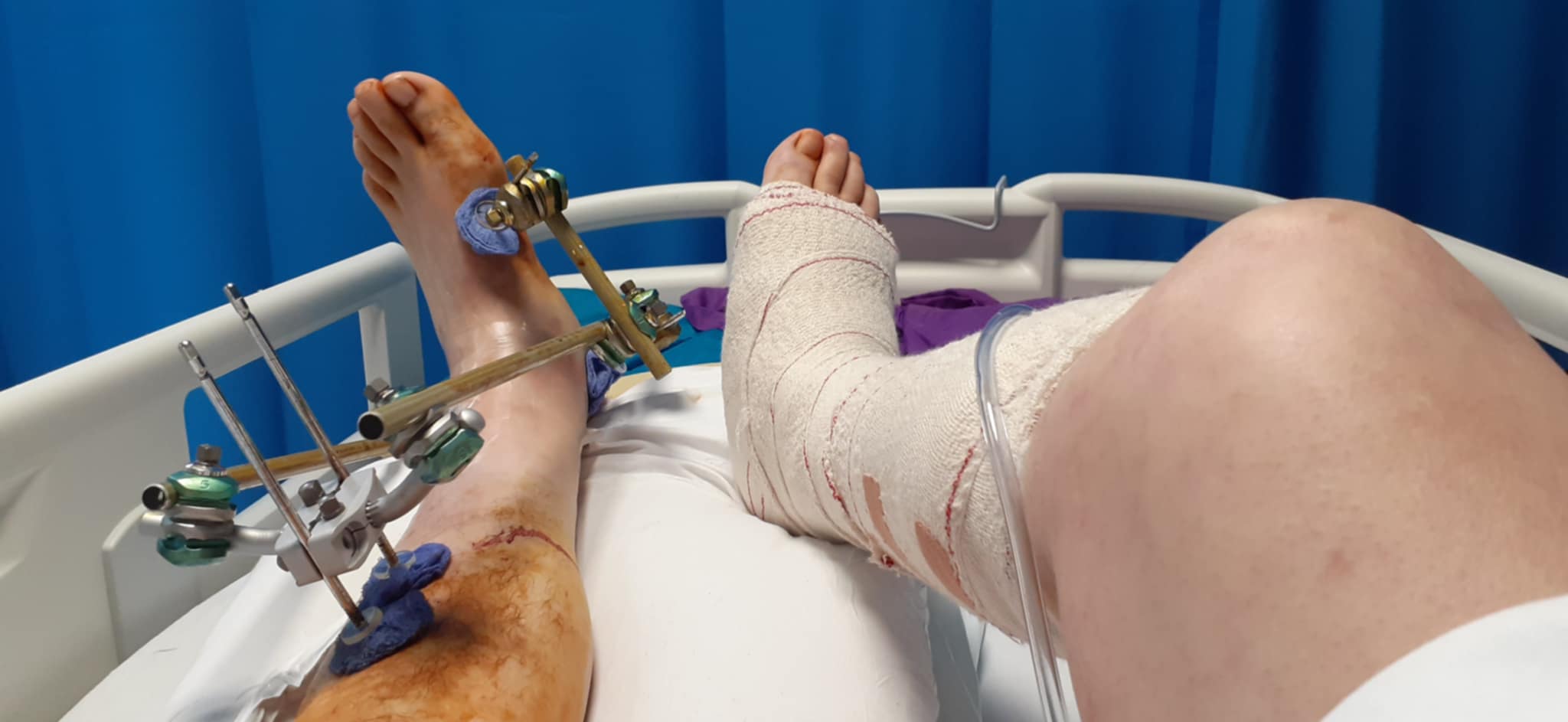The lower half of a man who is lying in a hospital bed. The right leg is in a cast and the left has a metal frame around it.